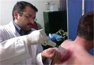 امروز روزه داران بعد از افطار حجامت کنند