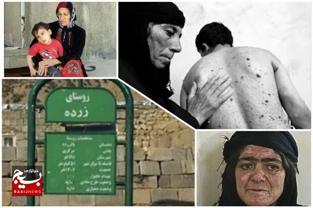 روایتی از بمباران شیمیایی هیروشیمای ایران