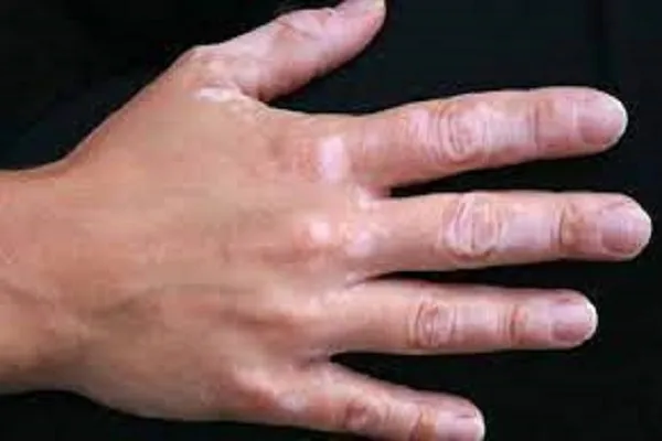 آغاز ارائه خدمات درمانی بیماری پیسی در شیراز
