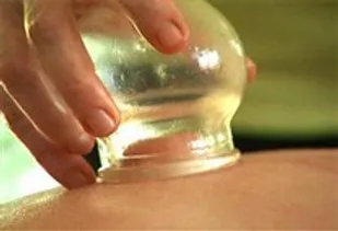 در فصل آبان حجامت کنید/ دموی&zwnj;ها و صفراوی&zwnj;ها در اولویت حجامت هستند