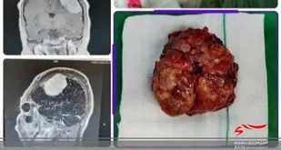 تومور مننژیوم برای اولین بار از مغز بیمار پارس آبادی خارج شد